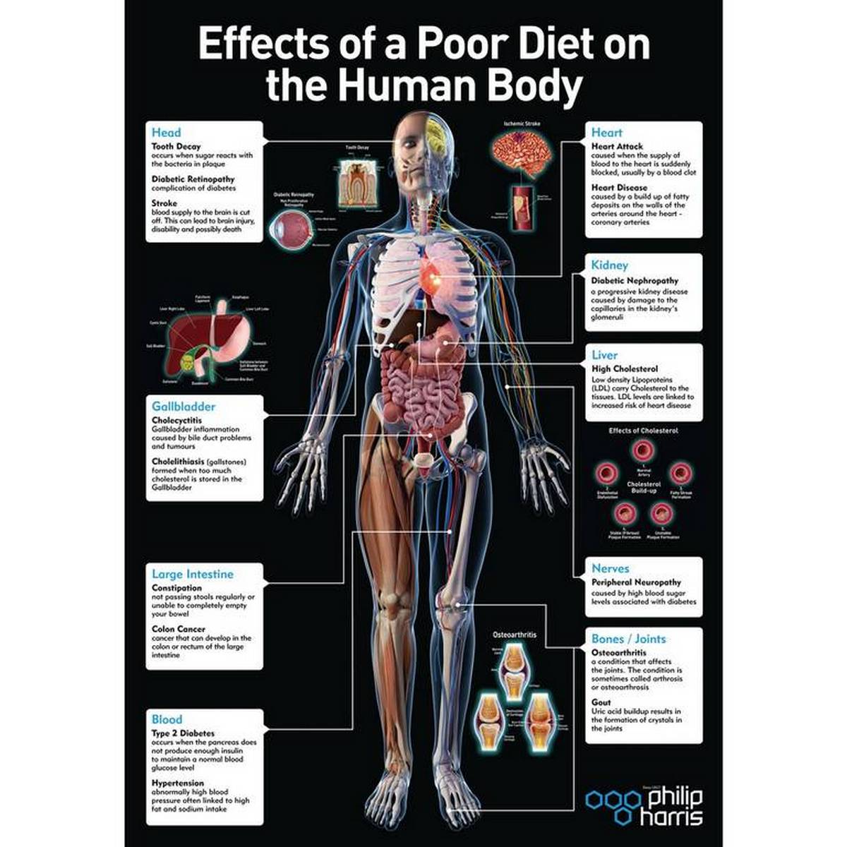 Effects Of A Poor Diet Poster